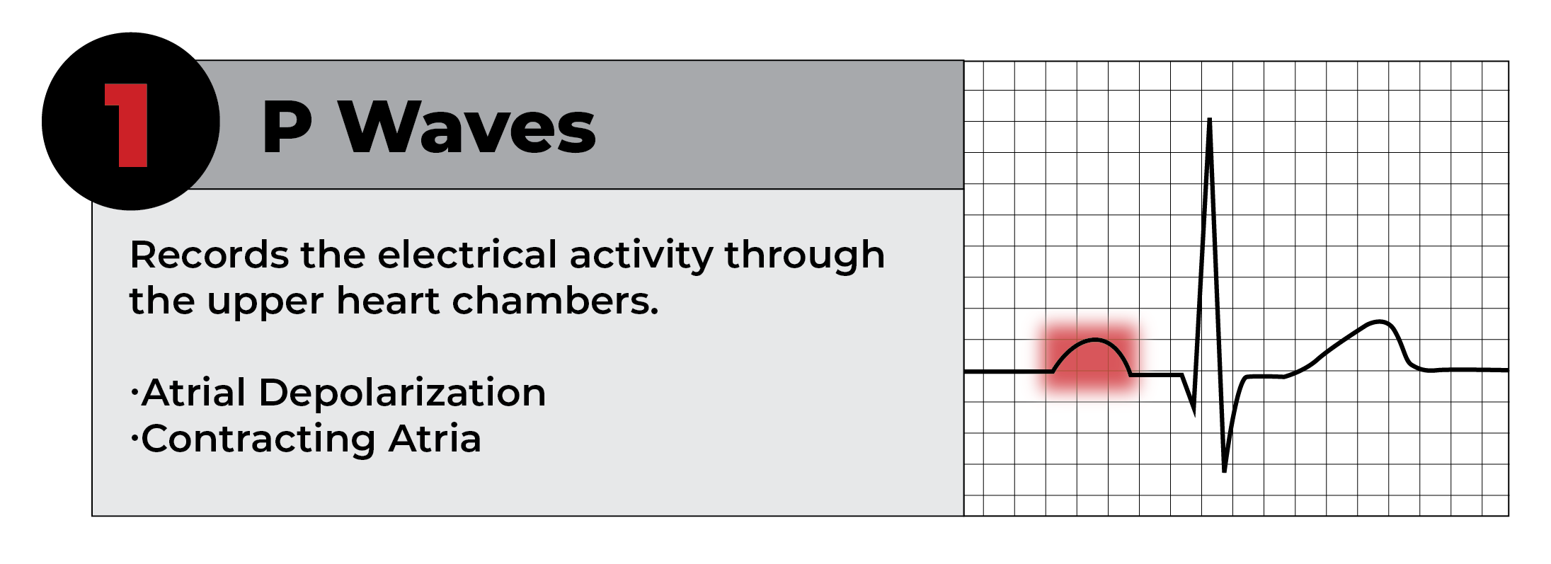 Understanding EKG Patterns