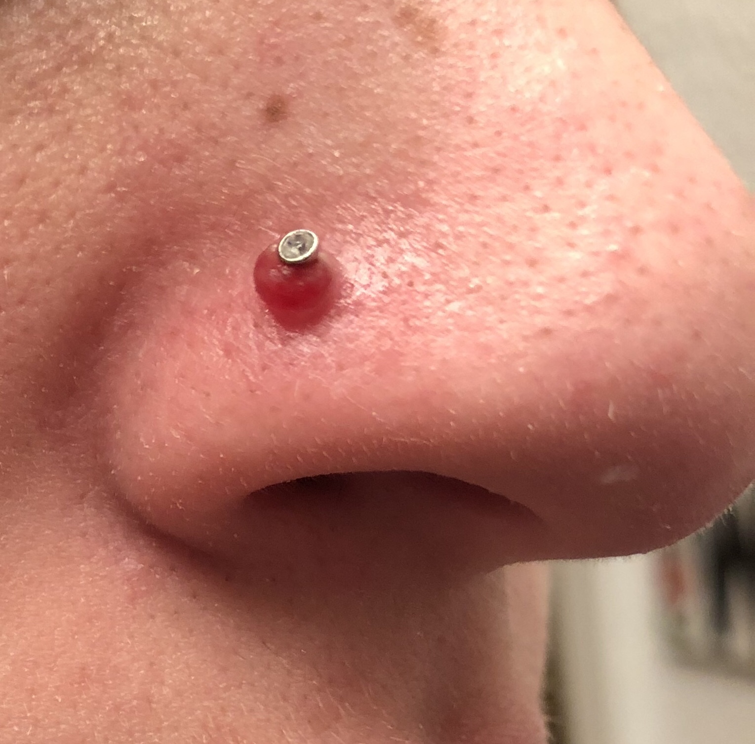 How to Get Rid of Piercing Bump