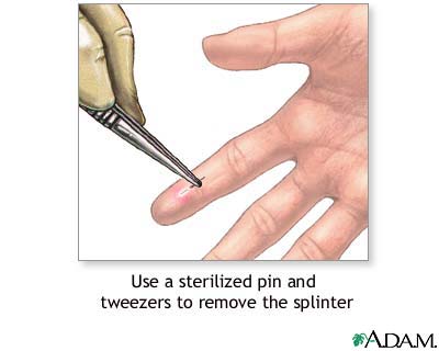 Effective Splinter Removal Techniques